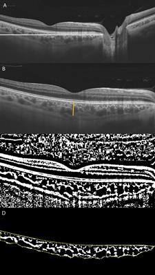 Choroidal Vascularity Index in CHM Carriers